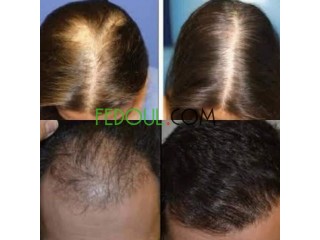 علاج طبيعي لتساقط الشعر